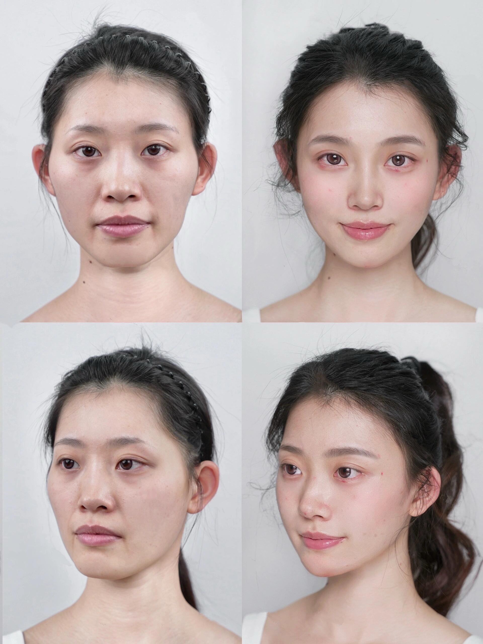 上海哪里做幼态脸做的好 多少钱(图2)