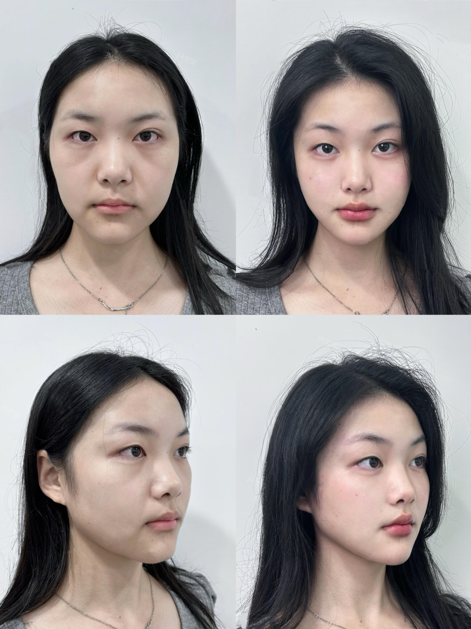 幼态脸做完多久可以看到效果真的有用吗