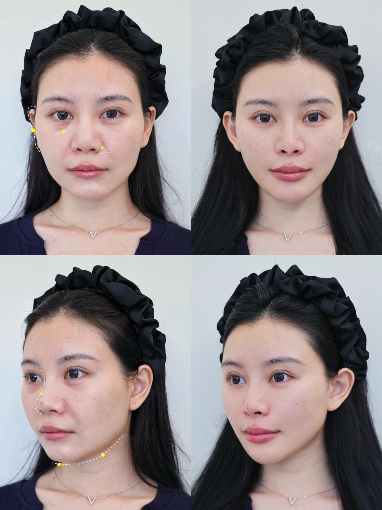 想打造幼态脸的姐妹看过来，哪里做幼态脸更靠谱(图2)