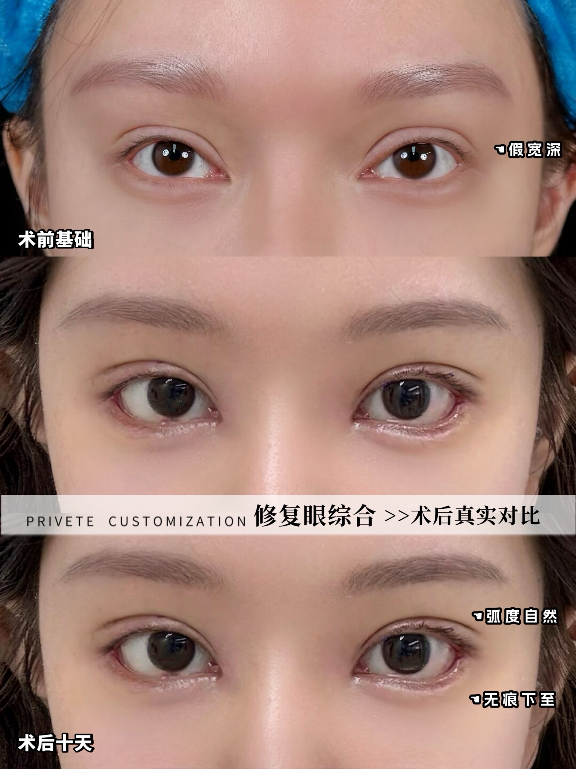 幼态脸真的没有恢复吗 做完幼态脸多久可以上班(图3)